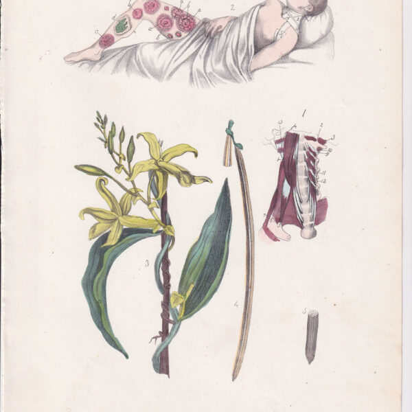 Tavola anatomica, infezioni batteriche, 1839