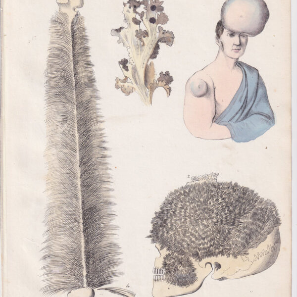 Tavola anatomica, cranio, tumore, 1839