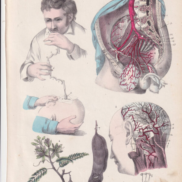 Tavola anatomica, trapanazione cranio, 1839
